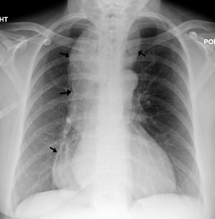 Achalasia cardia