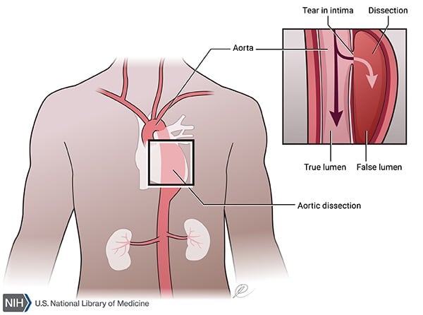 Aortic dissection