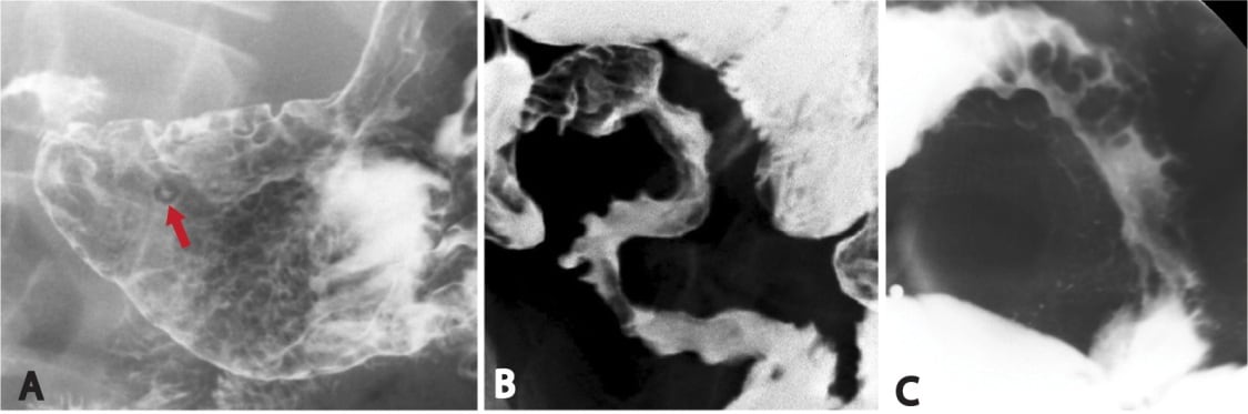 Flouroscopy in Crohn's disease