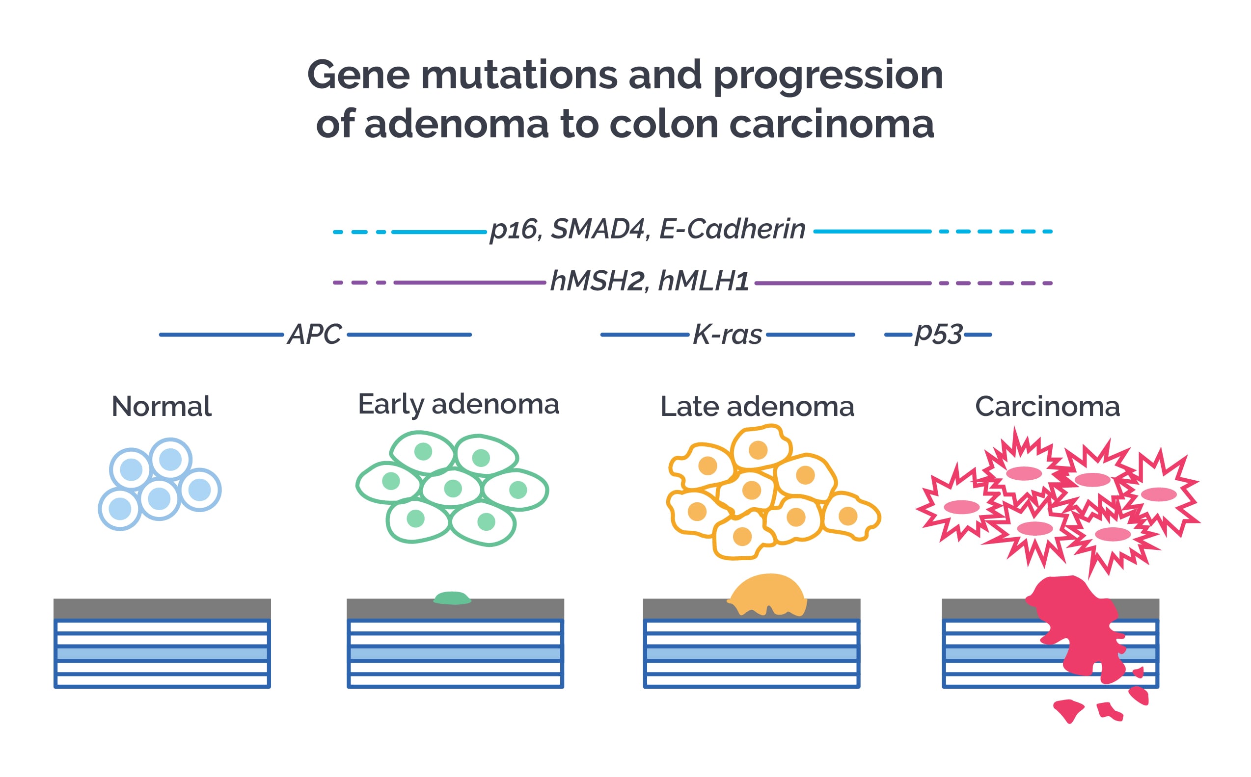 Adenoma to carcinoma sequence