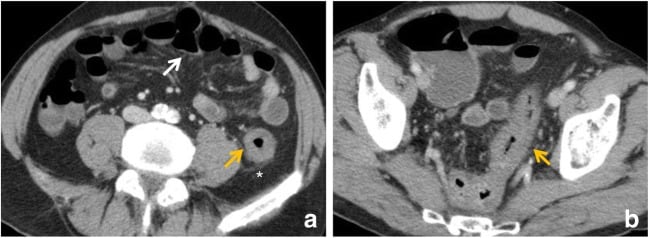 Ischemic colitis