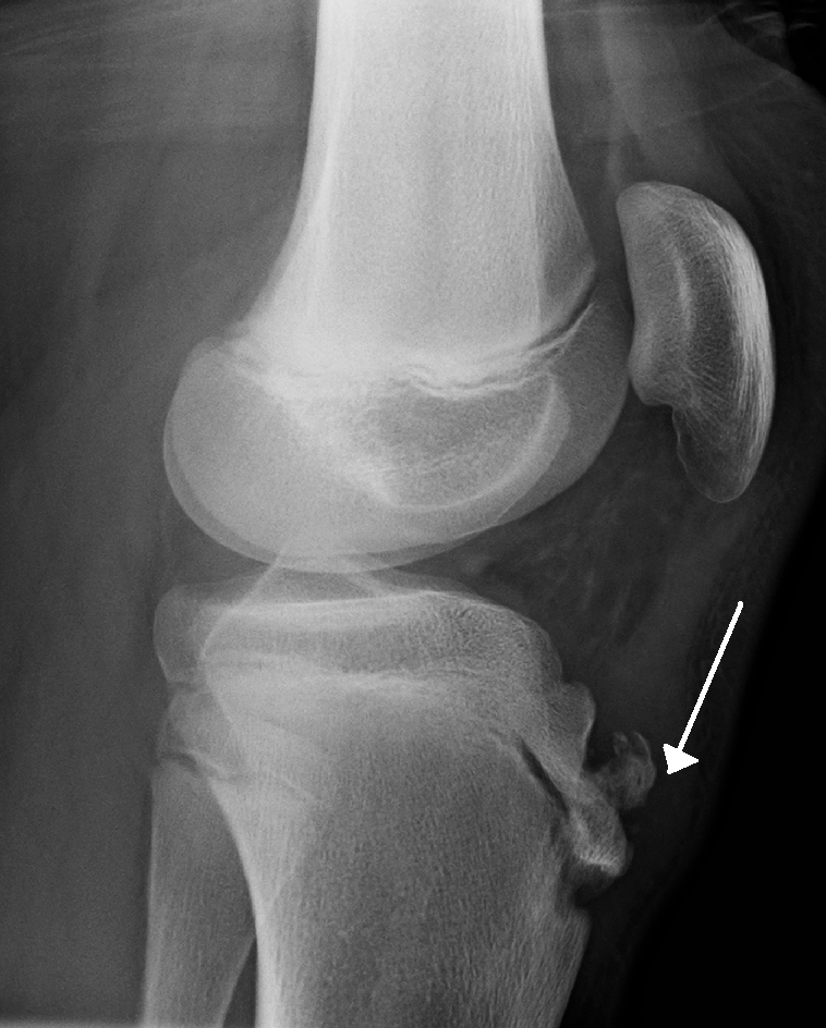 Osgood-Schlatter disease of knee showing fragmentation of the tibial tuberosity