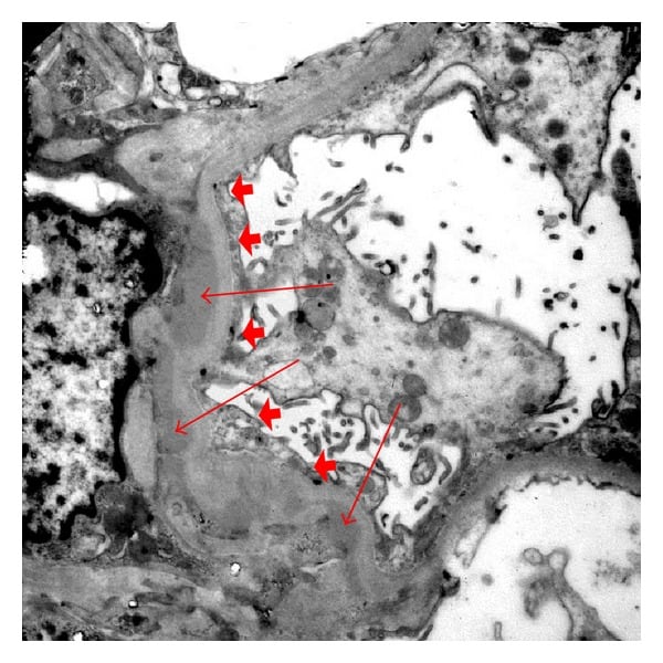 Podocyte foot effacement