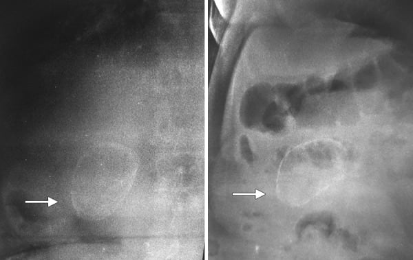 Porcelain gallbladder