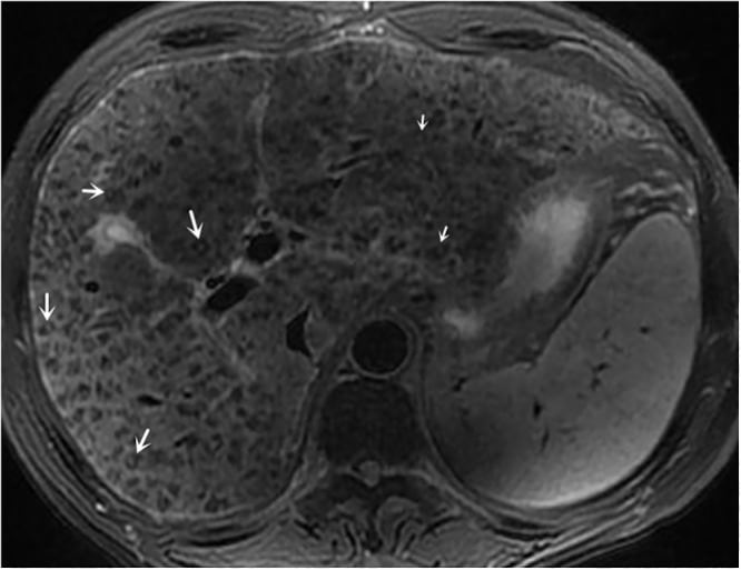 Primary biliary cirrhosis with halo sign