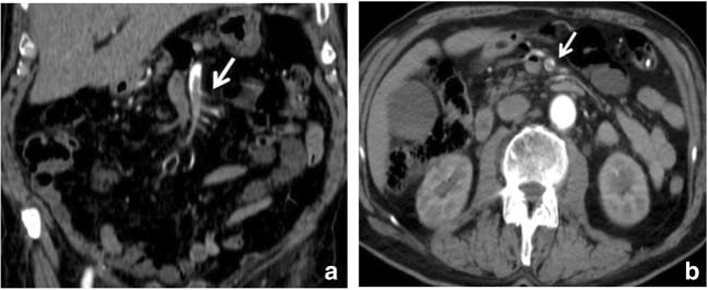 SMA thrombosis