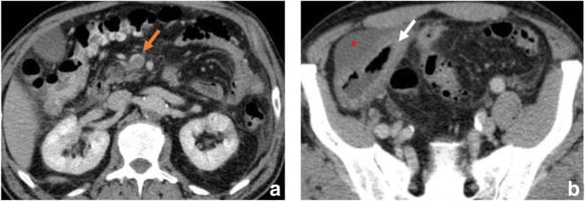 Superior mesenteric vein thrombosis