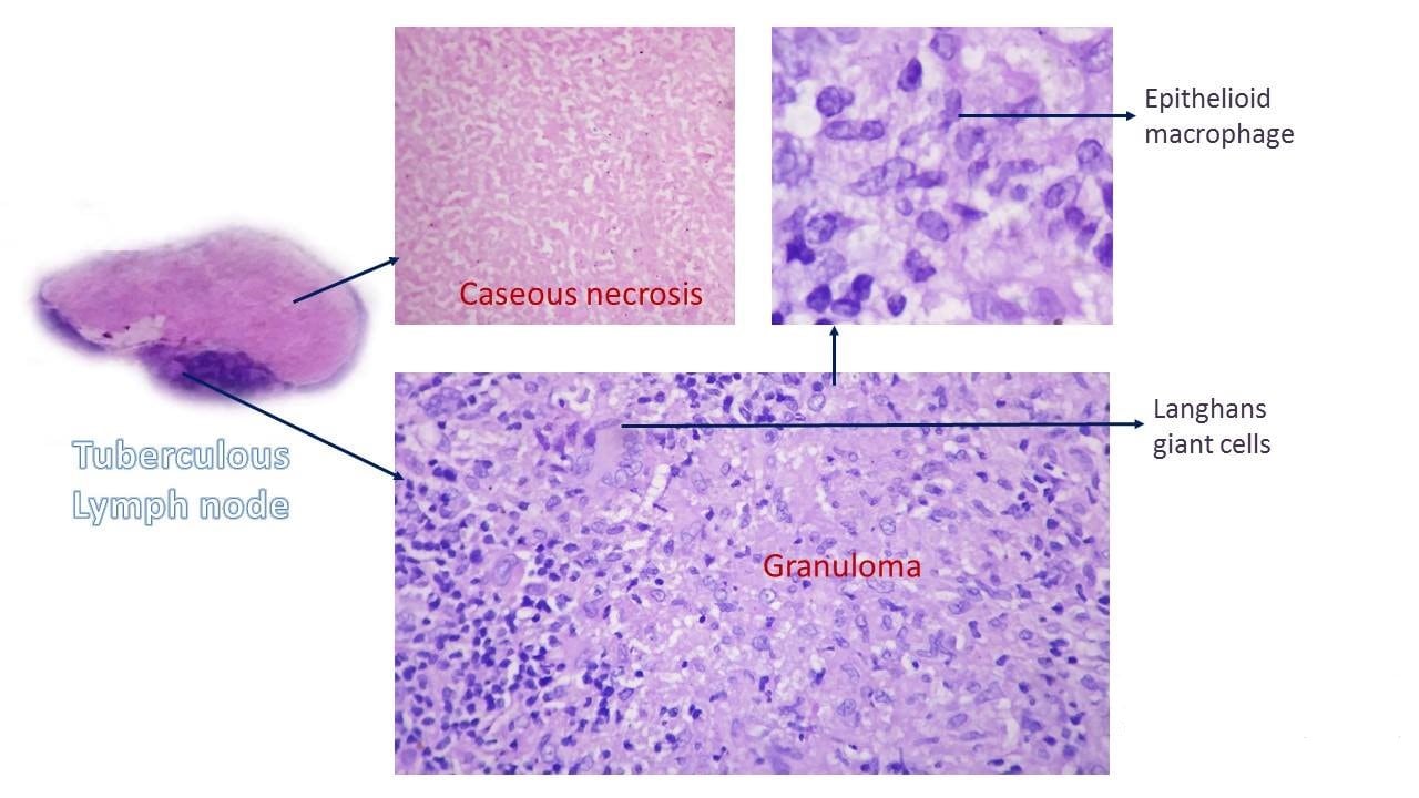 caseous necrosis vs liquefactive necrosis