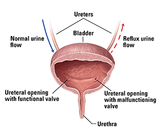 VUR