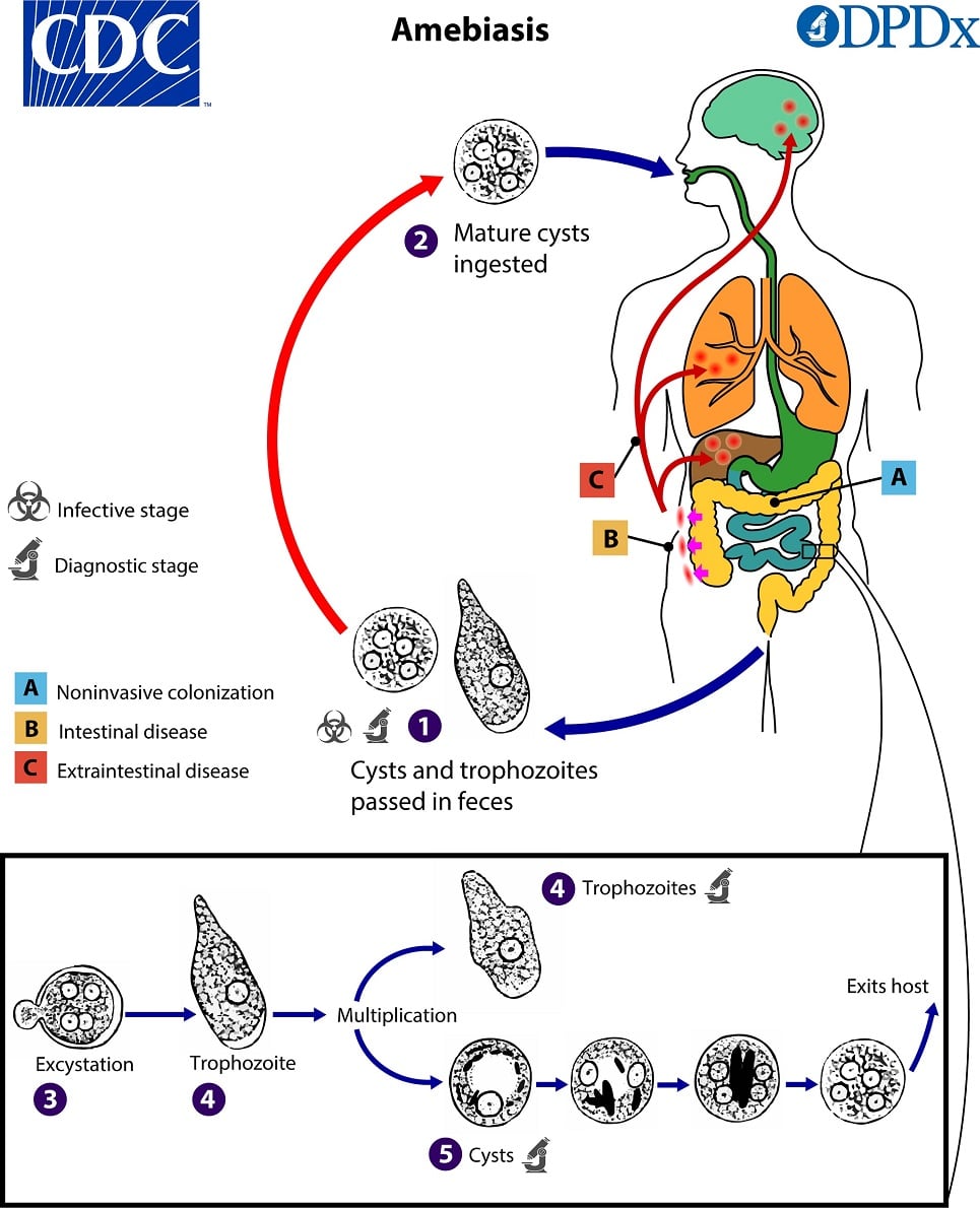 Amebiasis