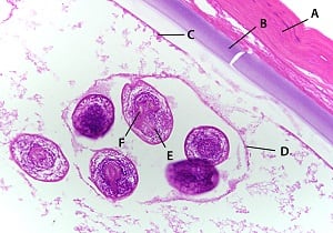 Hydatid cyst biopsy