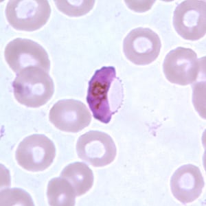 Gametocytes falciparum