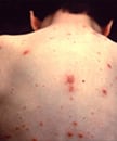 Chickenpox rash