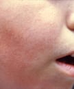 Fifth disease rash