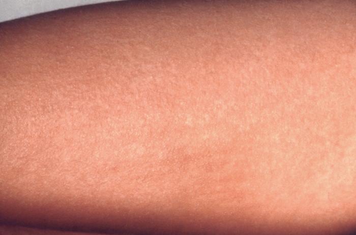 Scarlet fever rash