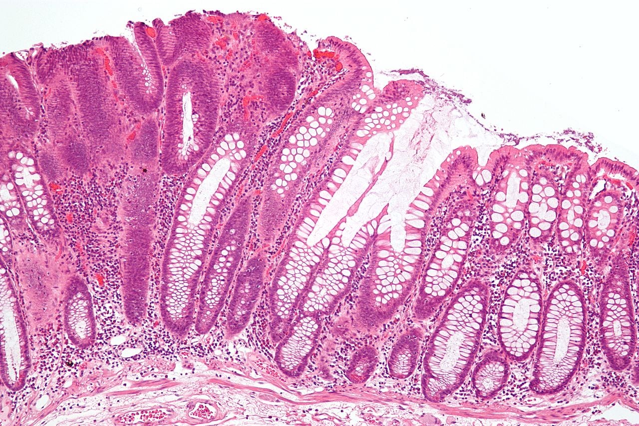 Tubular adenoma