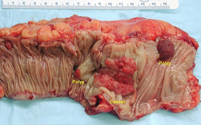 Colon polyp and cancer