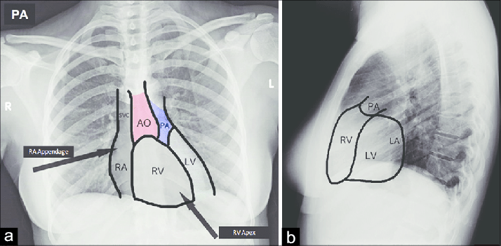 Heart on CXR