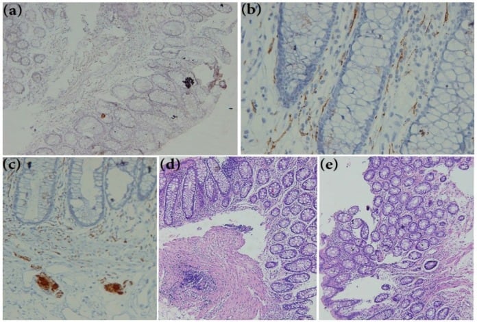 Hirschsprung disease