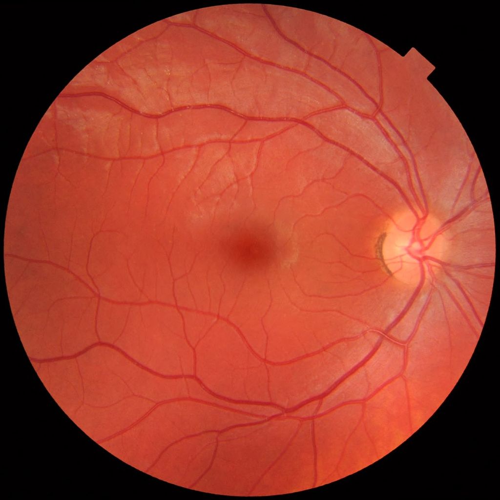 Normal fundus