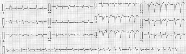 Atrial fibrillation with ST depression