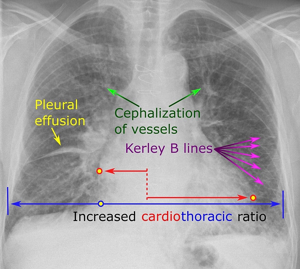 Cardiac failure