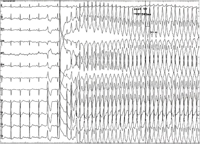 VT ECG